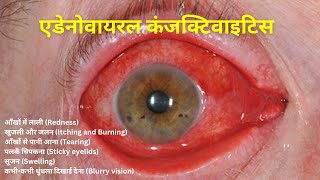 एडेनोवायरल कंजक्टिवाइटिस adenoviral conjuctivitiesआँखों में लाली Redness Itching and Burning [upl. by Ydnarb]