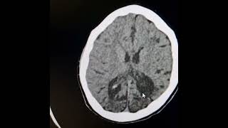 Bilateral chronic occipitoparietal infarctsDystrophic calcifications thickened adjacent calvarium [upl. by Vander]