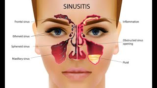 Sinus surgery patient information video [upl. by Naihtniroc]