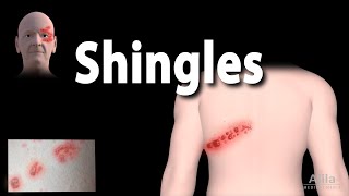 Shingles Pathophysiology Symptoms 3 stages of Infection Complications Management Animation [upl. by Esiahc]