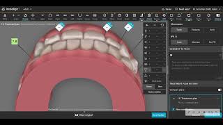 Deep Dive into a clincheck Tip v Torque For practitioners only or youll be bored [upl. by Nitsyrc]