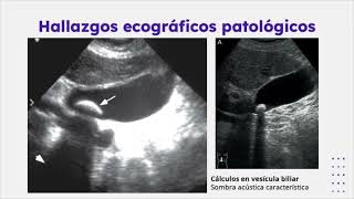 Diagnóstico por Imagen de Pancreatitis Aguda [upl. by Huston]