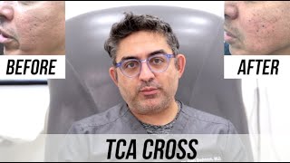 TCA Cross Acne Scar Treatment Before VS After [upl. by Iaverne]