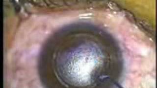 Femtosecond Lenticule Extraction FLEx A new paradigm for LASIK [upl. by Dianne]