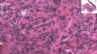 Meningioma  Histopathology [upl. by Sukramal]