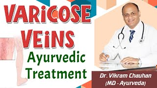 Varicose Veins Ayurvedic Treatment  Dr Vikram Chauhan [upl. by Siramaj]