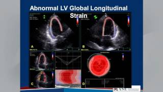 Echocardiographic Assessment of LV Diastolic Function Webinar [upl. by Narag]