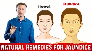 What is Jaundice – Causes amp Treatment Covered by DrBerg [upl. by Gussy63]