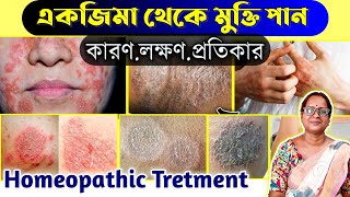 একজিমা দূর করার উপায়  eczema homeopathic medicine bangla  how to cure eczema in bangla [upl. by Maxama]