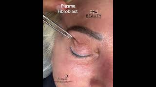 Plasma fibroblast is a noninvasive treatment that tightens skinplasmafibroblast plasmapen [upl. by Wivina]