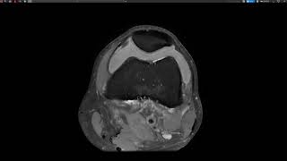 Knee injury LCL Bursa [upl. by Aicilet]