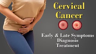 Cervical Cancer  HPV  Causes  Symptoms  Staging amp Treatment [upl. by Garling795]