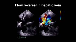 Echocardiography Essentials Spotting tricuspid and pulmonary valve disease [upl. by Picco518]