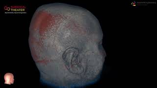 Resection of Brain Stem Cavernoma Minimally Invasive Surgery [upl. by Philan]