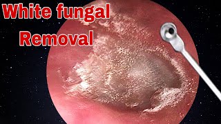 Ear Wax amp White Fungal Removal  Doctor Anh [upl. by Jerald]