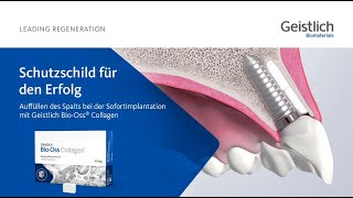 Schutzschild für den Erfolg  Geistlich BioOss® Collagen 50mg [upl. by Eadmund]