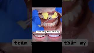 composite veneers nhakhoacodofa răngsứthẩmmỹ shorts short dentist dental [upl. by Adnovahs178]