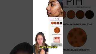 Best Serum for Acne Marks  Clear Skin with These Top Picks  Skincare SkinCareRoutine [upl. by Kciv99]