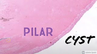 Trichilemmal CystPilar Cyst 5Minute Pathology Pearls [upl. by Auqinu]