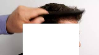 Receding Hairline Find out how advanced hair restoration works miracles [upl. by Nerrawed]