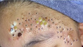 Big Cystic Acne Blackheads Extraction Blackheads amp Milia Whiteheads Removal Pimple Popping  5245 [upl. by Shiller]