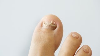 How to prevent and treat nail fungus [upl. by Meid]