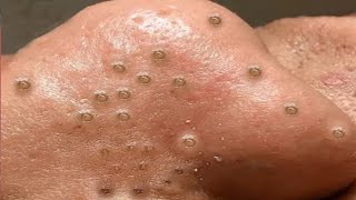 Big Cystic Acne Blackheads Extraction Blackheads amp Milia Whiteheads Removal Pimple Popping  3692 [upl. by Yanaton519]