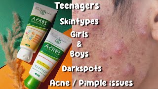 Facewash for acne  Acnes facewash review  pimple solution face wash Acne treatment [upl. by Odrawde]