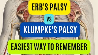 Erbs Palsy Vs Klumpkes Palsy  Brachial Plexus Injury  Easy Way To Remember [upl. by Legna]