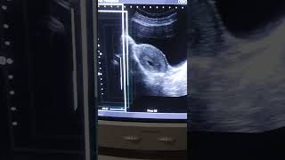 Gestational sac of 4 weeks with transabdominal ultrasound by medical radiology [upl. by Els779]