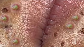 Big Cystic Acne Blackheads Extraction Blackheads amp Milia Whiteheads Removal Pimple Popping  3699 [upl. by Ainoloppa]