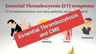 CME and Adult Essential Thrombocytosis [upl. by Eniac734]