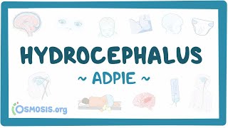 Hydrocephalus Nursing Process [upl. by Ellehcen]