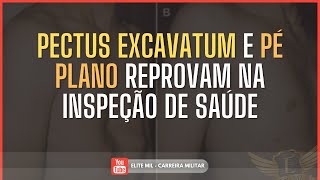 Peito escavado” e “pé plano” podem REPROVAR na Inspeção de Saúde [upl. by Bevash]