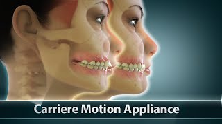 Carriere Motion Orthodontic Treatment  Curveia Dental Animation  Patient Education Video [upl. by Ynot181]