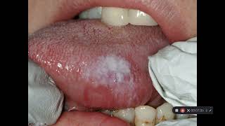 Oral cancer and precancer part 3 Leukoplakia and Erythroplakia [upl. by Ahsinav]