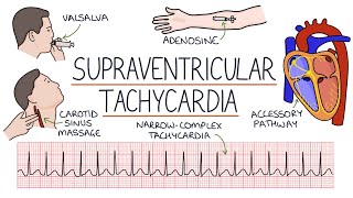 Understanding Supraventricular Tachycardia SVT [upl. by Roberta]