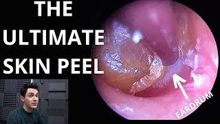 The Ultimate Skin Peel Dead Skin Lifted From Trapped Eardrum [upl. by Ain]