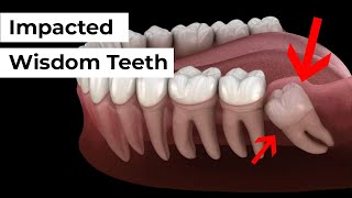 Impacted Wisdom Tooth Removal [upl. by Molli]