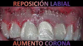 Reposición labial  gingivectomía y gingivoplastía cirugiaperiodontal periodoncia lipreposition [upl. by Penrod]