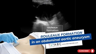 VASCULAR ULTRASOUND Rouleaux formation in an abdominal aortic aneurysm [upl. by Auqenwahs]