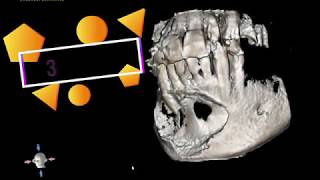 Mandibular Cyst [upl. by Eram]