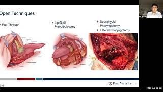 Surgical Treatment of Oropharyngeal Cancer  Dr Robert Brody [upl. by Allemat493]