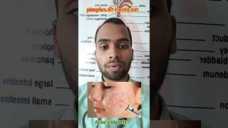 Pimples  Acne Vulgaris Homoeopathic Treatment [upl. by Atiuqam]