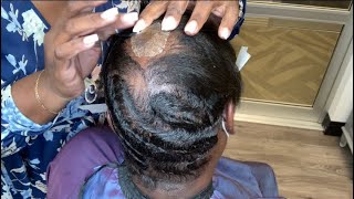 Covering a scarred Alopecia bald spot  Hair extensions for Alopecia [upl. by Latisha]