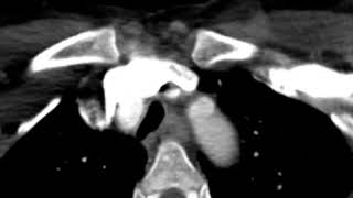 Gated CT Chest Angiography Bicuspid Aortic Valve [upl. by Akemahc]