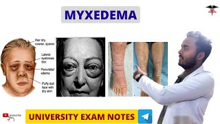 Myxedema  Hypothyroidism  Endocrine Physiology [upl. by Anitnoc]