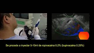 Neurólisis de plexo celiaco guiado por ultrasonido endoscópico [upl. by Salchunas170]