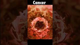 Esophageal Cancer cancer mbbs savelife [upl. by Lehcyar]