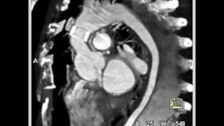 Type B dissection with compression of true lumen [upl. by Spears]